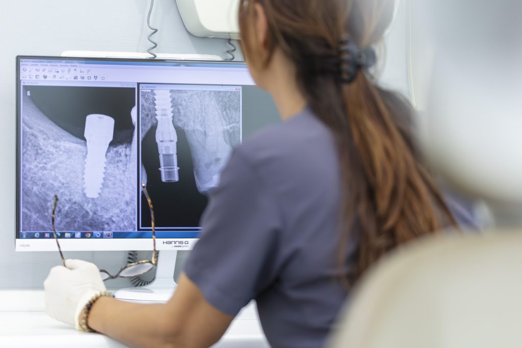 implantes-dentales-clinica-dental-smile-2