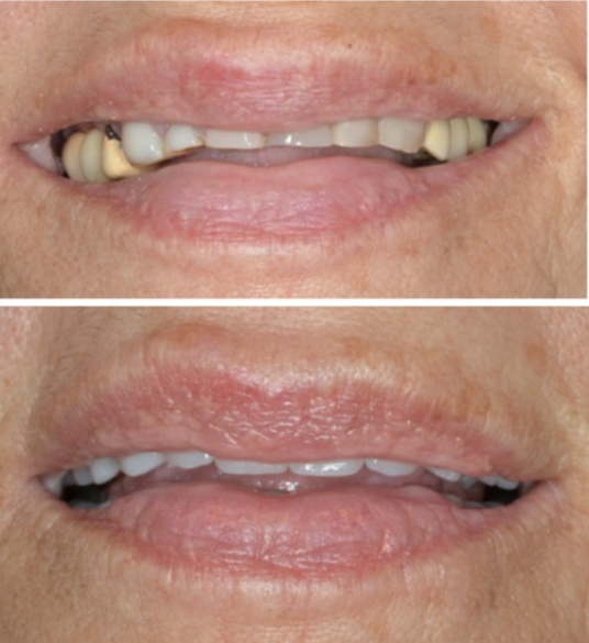 Aumento de dimensión vertical