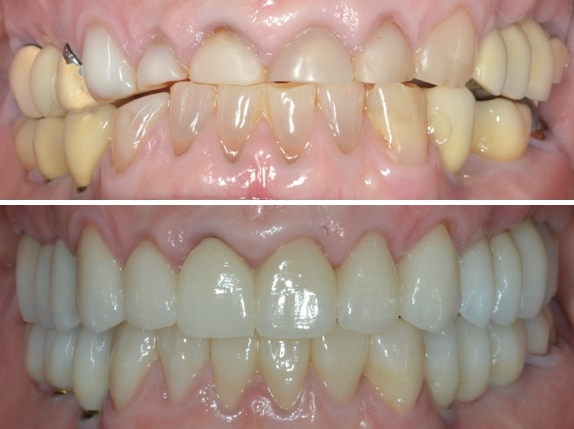 Aumento de dimensión vertical