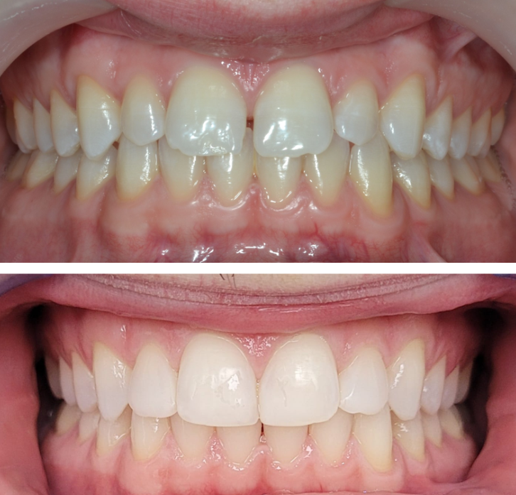 Carillas de composite