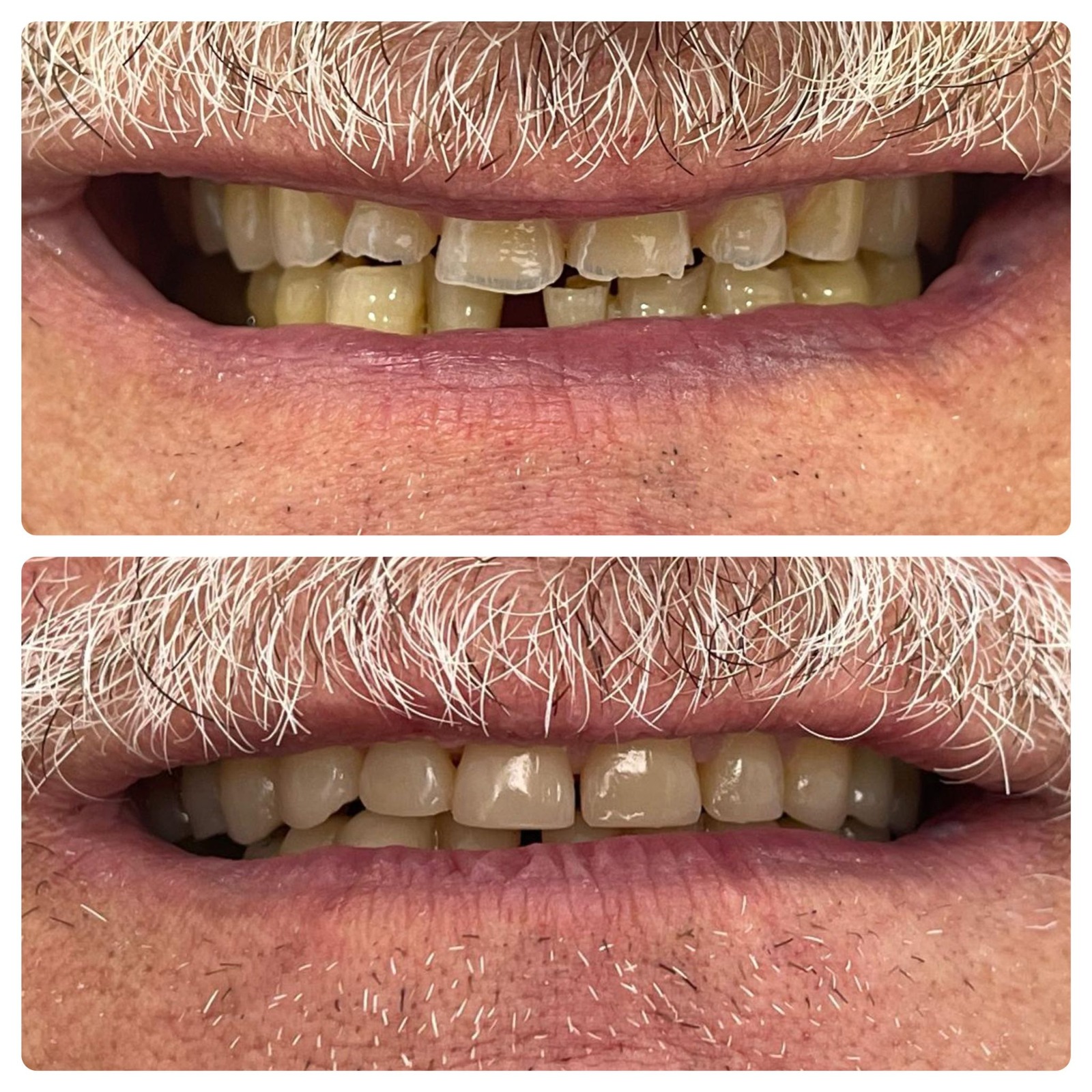 Aumento de dimensión vertical